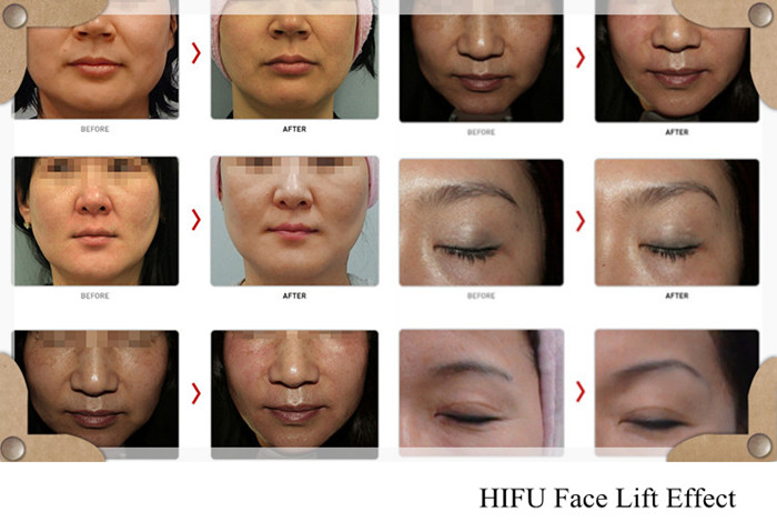 hifu-face-lift-effect